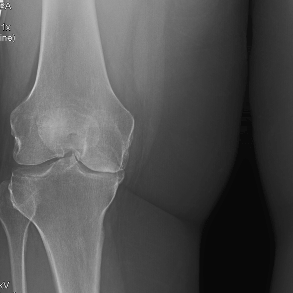 My other knee is a source of confusion with the pain of Parkinson's now